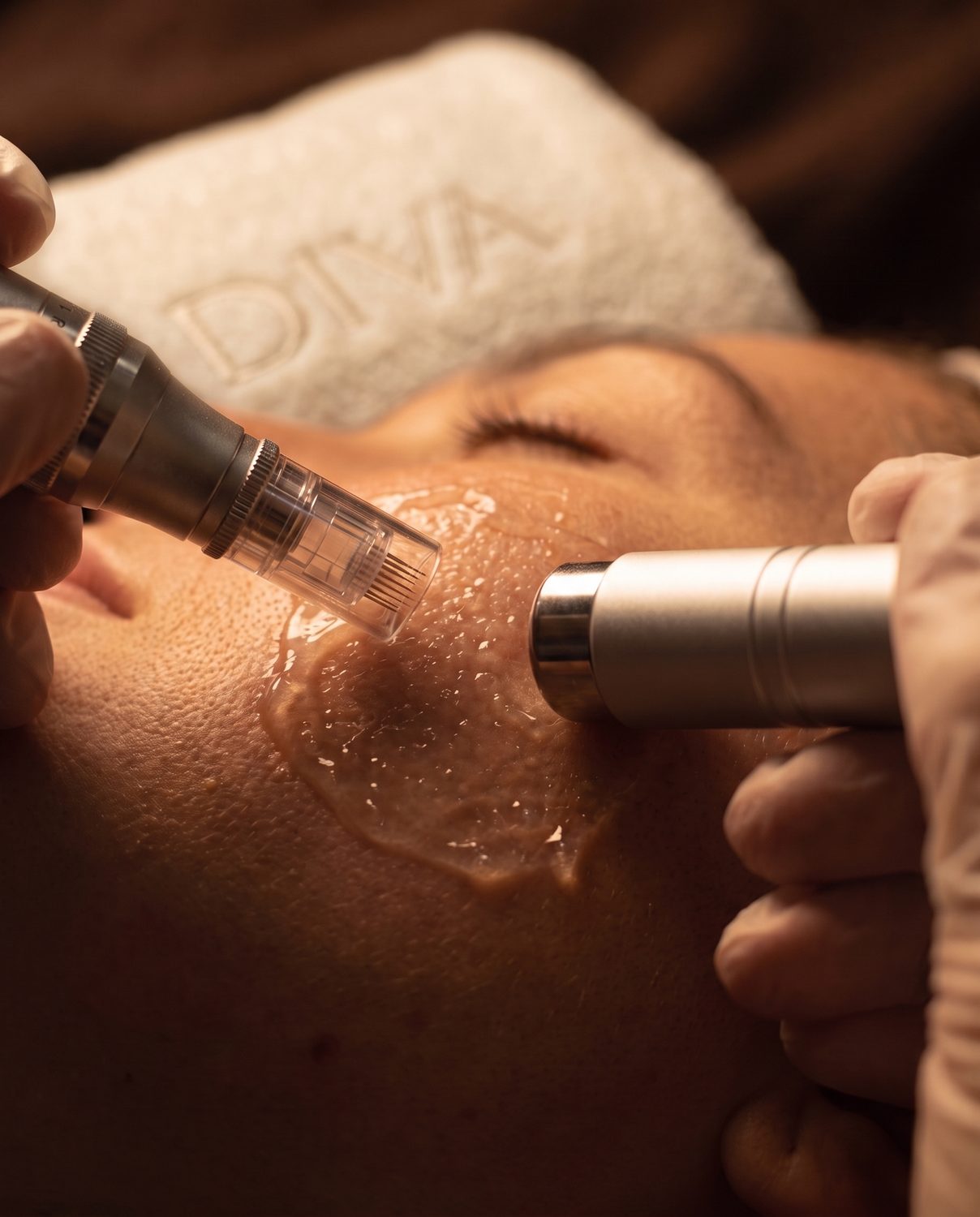 Microneedling și radiofrecvență
